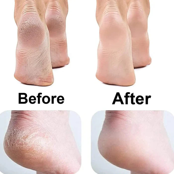 Electric Callus Remover for Feet